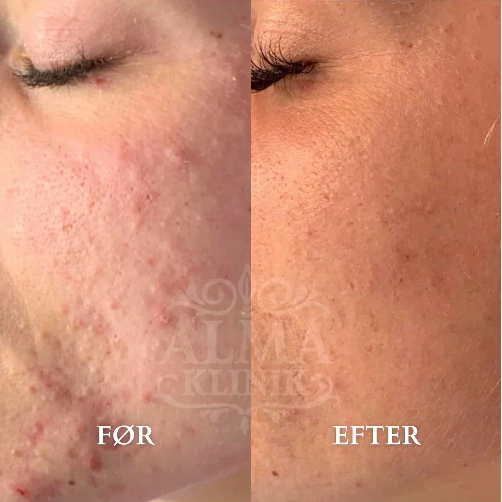 Microneedling mod acne — før og efter hos Alma