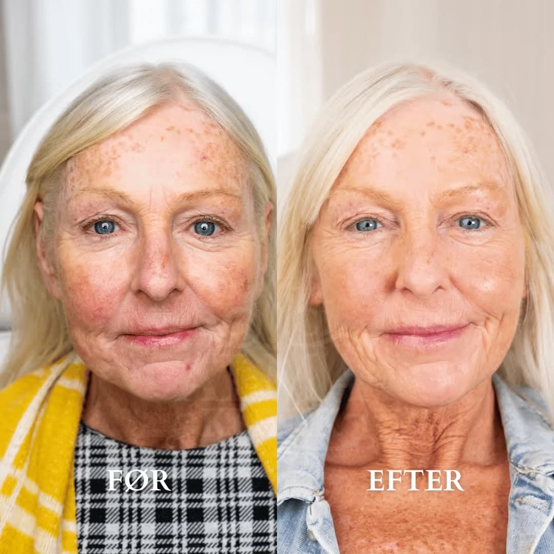 Microneedling efter 3 behandlinger — før og efter hos Alma